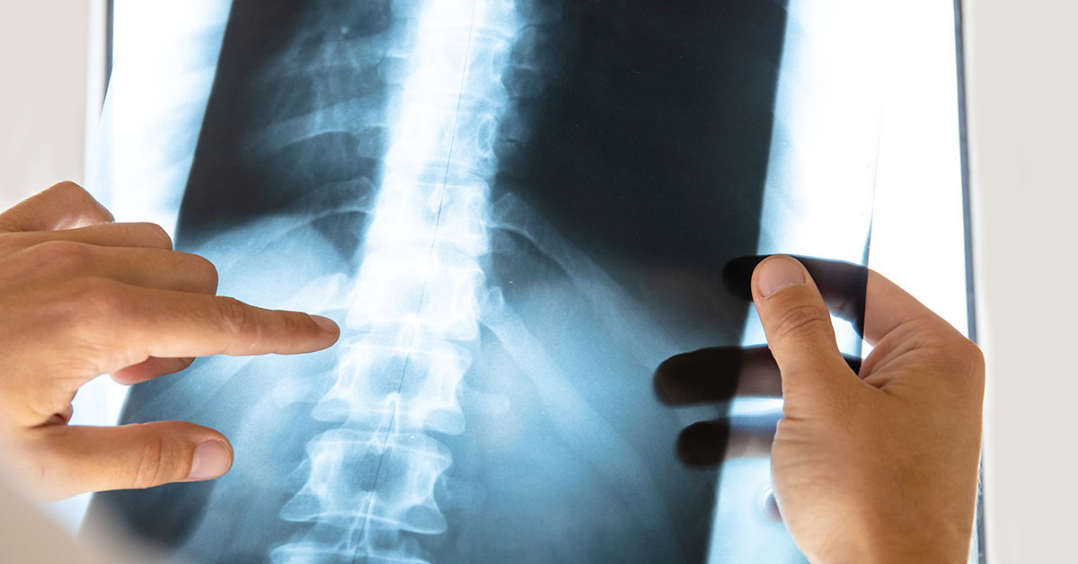 doctor examines x-ray picture of human spine; blog: diagnosing five common spine conditions